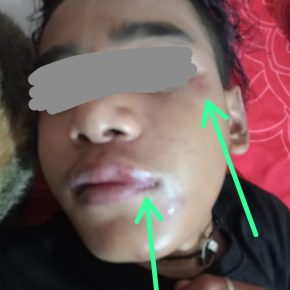 Penganiayaan Terhadap Anak Remaja di Kronjo: Keluarga Tuntut Pelaku